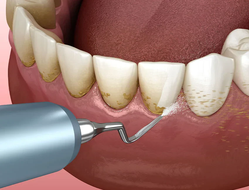 Teeth Cleaning at The Smile Spa
