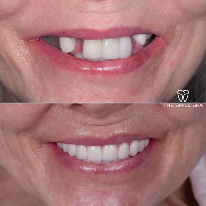 Dental Implants at The Smile Spa in Agoura Hills, CA before and after — case 5