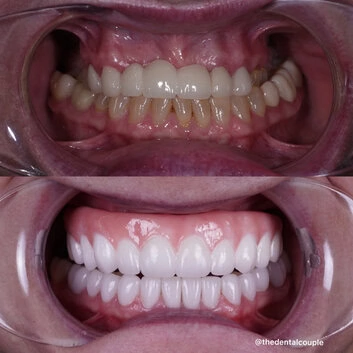 Before and after smile transformation at The Smile Spa — case 35