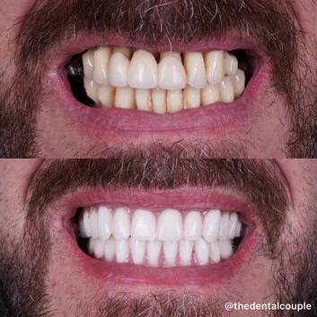 Before and after smile transformation at The Smile Spa — case 36