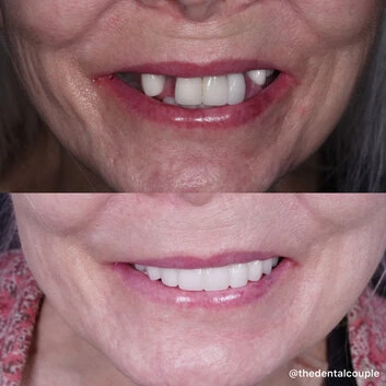 Before and after smile transformation at The Smile Spa — case 37