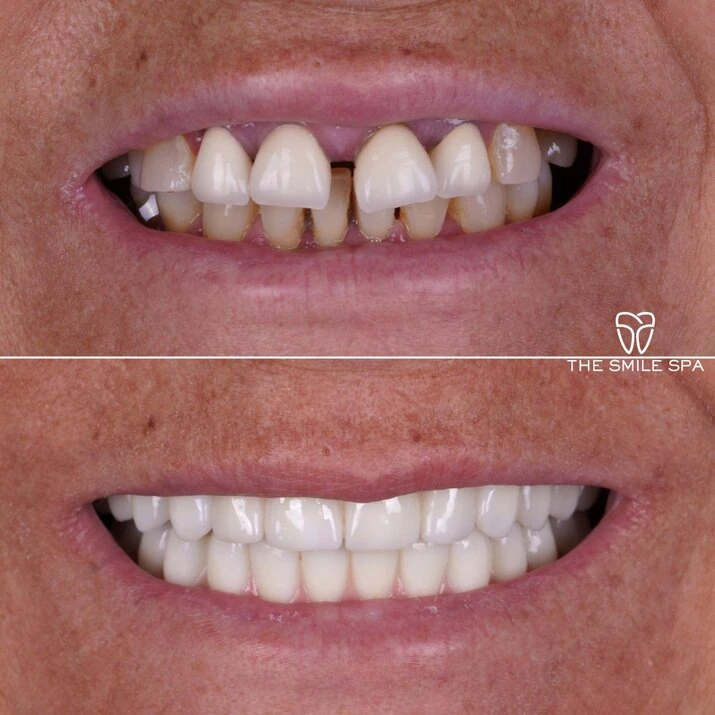 Dental Implants at The Smile Spa in Agoura Hills, CA before and after — case 6