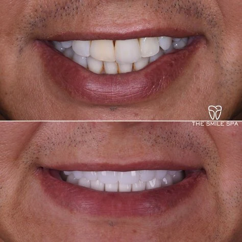 Dental Implants at The Smile Spa in Agoura Hills, CA before and after — case 7