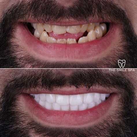 Dental Implants at The Smile Spa in Agoura Hills, CA before and after — case 8