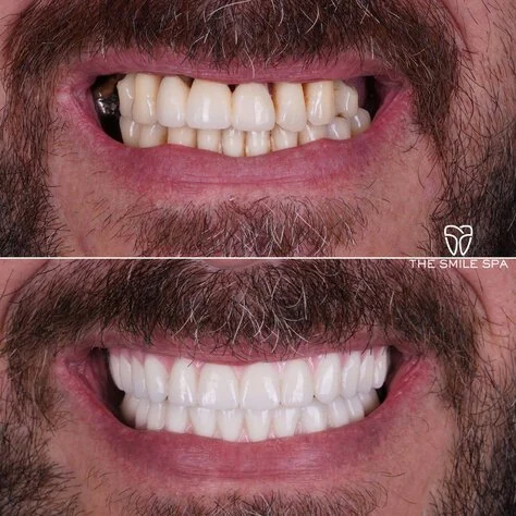 Dental Implants at The Smile Spa in Agoura Hills, CA before and after — case 9