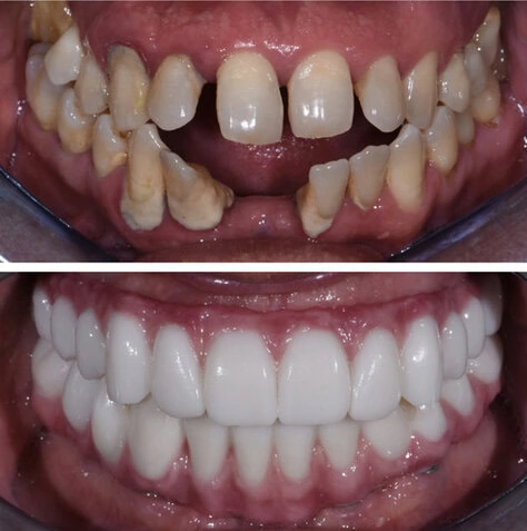 Dental Implants at The Smile Spa in Agoura Hills, CA before and after — case 10
