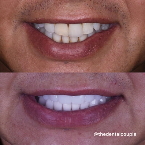 Dental Implants at The Smile Spa in Agoura Hills, CA before and after — case 11