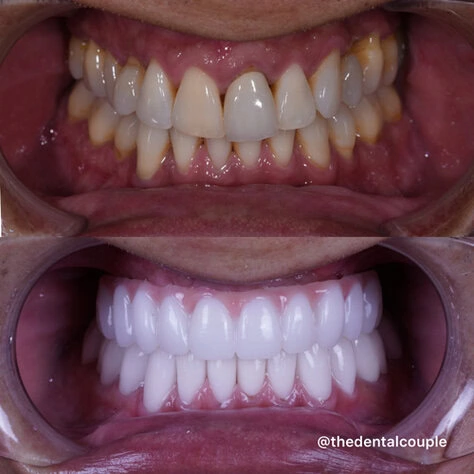 Dental Implants at The Smile Spa in Agoura Hills, CA before and after — case 12