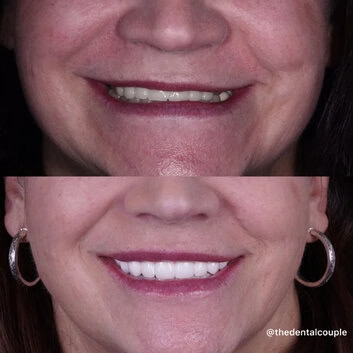 Before and after smile transformation at The Smile Spa — case 34