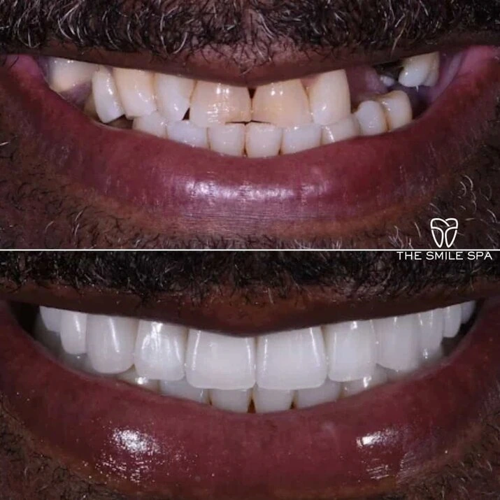 Dental Implants at The Smile Spa in Agoura Hills, CA before and after — case 1