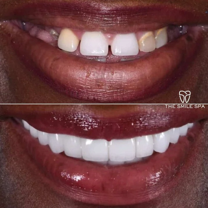 Dental Implants at The Smile Spa in Agoura Hills, CA before and after — case 2