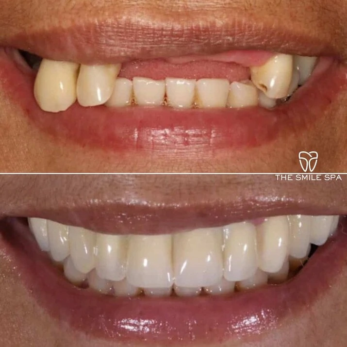 Dental Implants at The Smile Spa in Agoura Hills, CA before and after — case 3