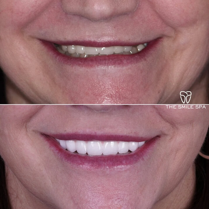 Dental Implants at The Smile Spa in Agoura Hills, CA before and after — case 4