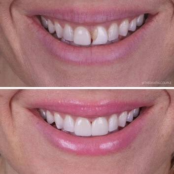 Before and after smile transformation at The Smile Spa — case 13