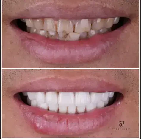 Before and after smile transformation at The Smile Spa — case 22