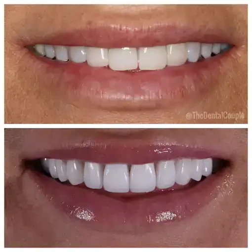 Before and after smile transformation at The Smile Spa — case 23