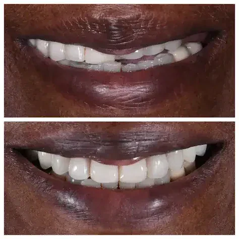 Before and after smile transformation at The Smile Spa — case 24
