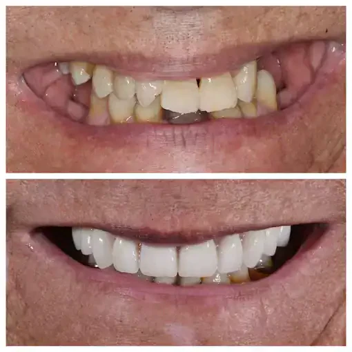 Before and after smile transformation at The Smile Spa — case 25