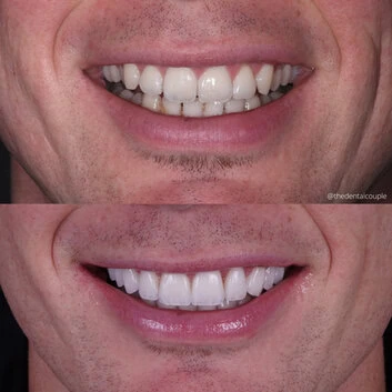 Before and after smile transformation at The Smile Spa — case 14