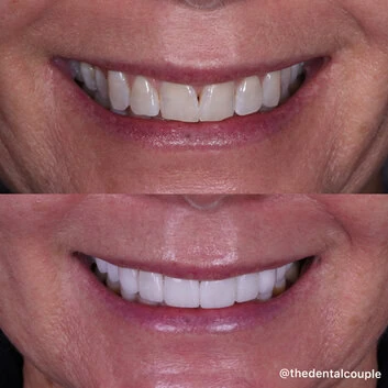 Before and after smile transformation at The Smile Spa — case 15