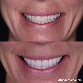 Before and after smile transformation at The Smile Spa — case 16