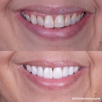 Before and after smile transformation at The Smile Spa — case 17