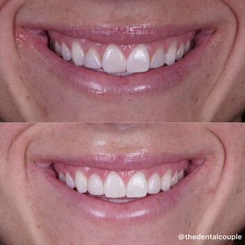 Before and after smile transformation at The Smile Spa — case 18