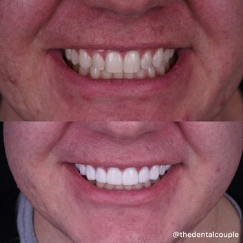 Before and after smile transformation at The Smile Spa — case 19