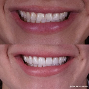 Before and after smile transformation at The Smile Spa — case 20