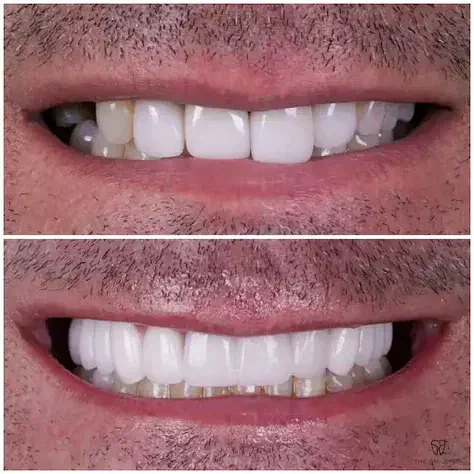 Before and after smile transformation at The Smile Spa — case 21