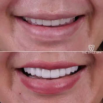 Smile Makeover at The Smile Spa in Agoura Hills, CA before and after — case 1