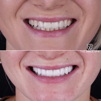 Smile Makeover at The Smile Spa in Agoura Hills, CA before and after — case 10