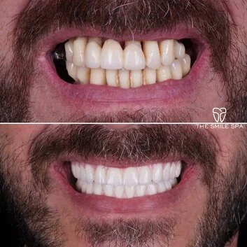 Smile Makeover at The Smile Spa in Agoura Hills, CA before and after — case 11