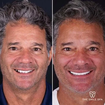 Smile Makeover at The Smile Spa in Agoura Hills, CA before and after — case 12