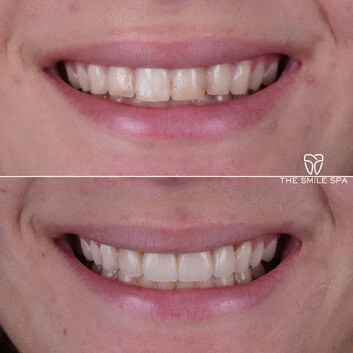 Smile Makeover at The Smile Spa in Agoura Hills, CA before and after — case 2