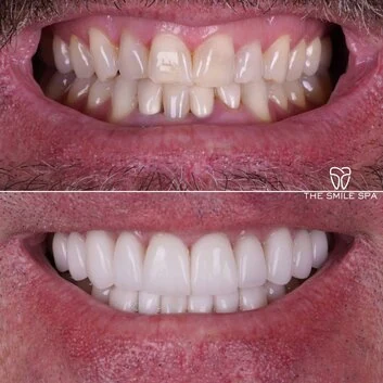 Smile Makeover at The Smile Spa in Agoura Hills, CA before and after — case 3