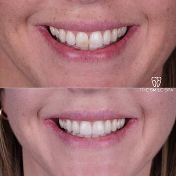 Smile Makeover at The Smile Spa in Agoura Hills, CA before and after — case 4