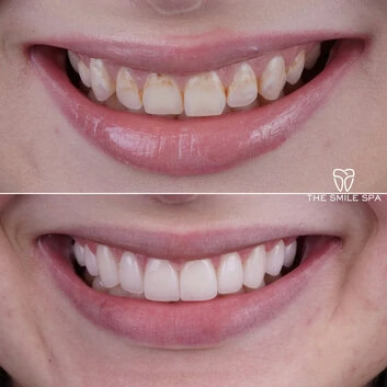 Smile Makeover at The Smile Spa in Agoura Hills, CA before and after — case 5