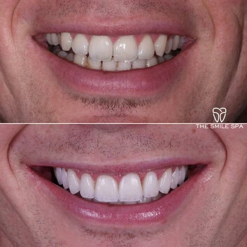Smile Makeover at The Smile Spa in Agoura Hills, CA before and after — case 6