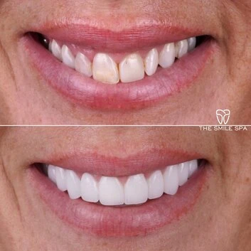 Smile Makeover at The Smile Spa in Agoura Hills, CA before and after — case 7