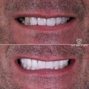 Smile Makeover at The Smile Spa in Agoura Hills, CA before and after — case 8