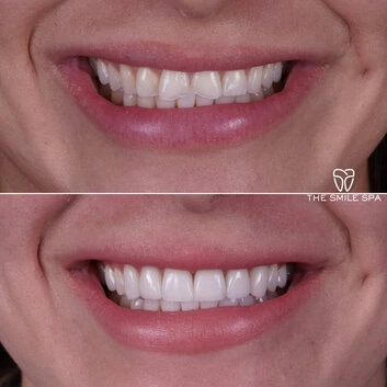 Smile Makeover at The Smile Spa in Agoura Hills, CA before and after — case 9
