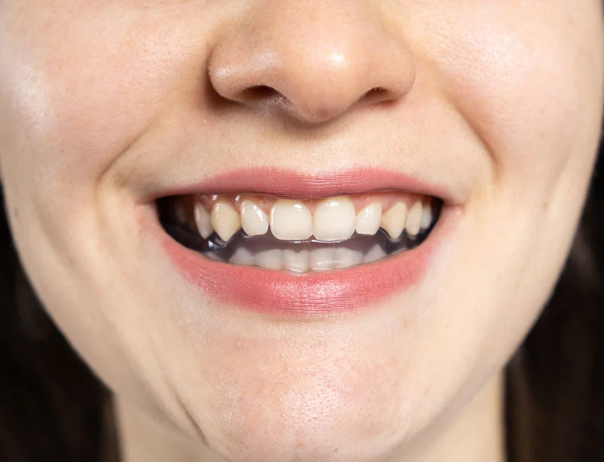 Botox at The Smile Spa in Agoura Hills, CA — How Dentists Use Botox to Treat Teeth Grinding