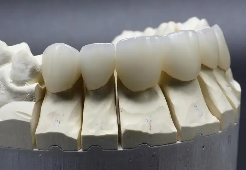Porcelain Veneers in Agoura Hills, CA