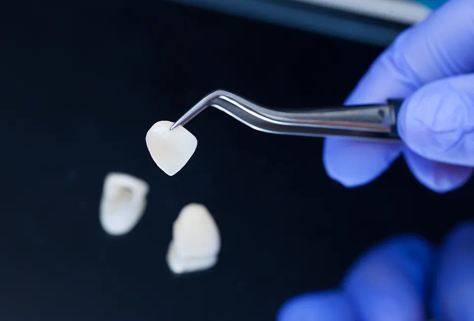 veneers-lab (1) How do veneers work